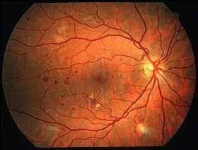 Global Diabetic Retinopathy Market Insight
