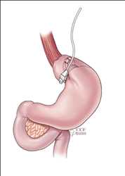 Adjustable Gastric Banding