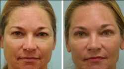 Global Blepharoplasty Market