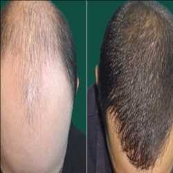Global Hair Transplant Market