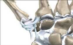 Artificial Tendons and Ligaments