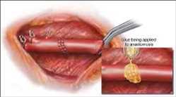 Tissue Sealants and Tissue Adhesive