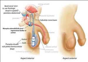Implants testiculaires Market