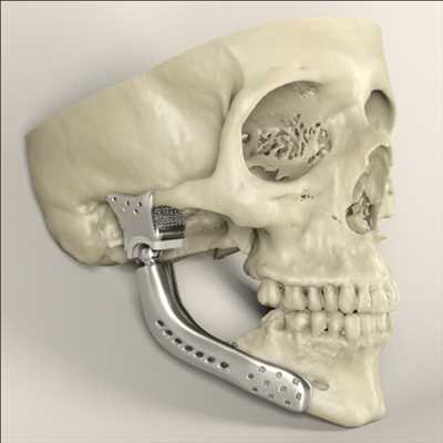 Implants médicaux imprimés en 3D Market